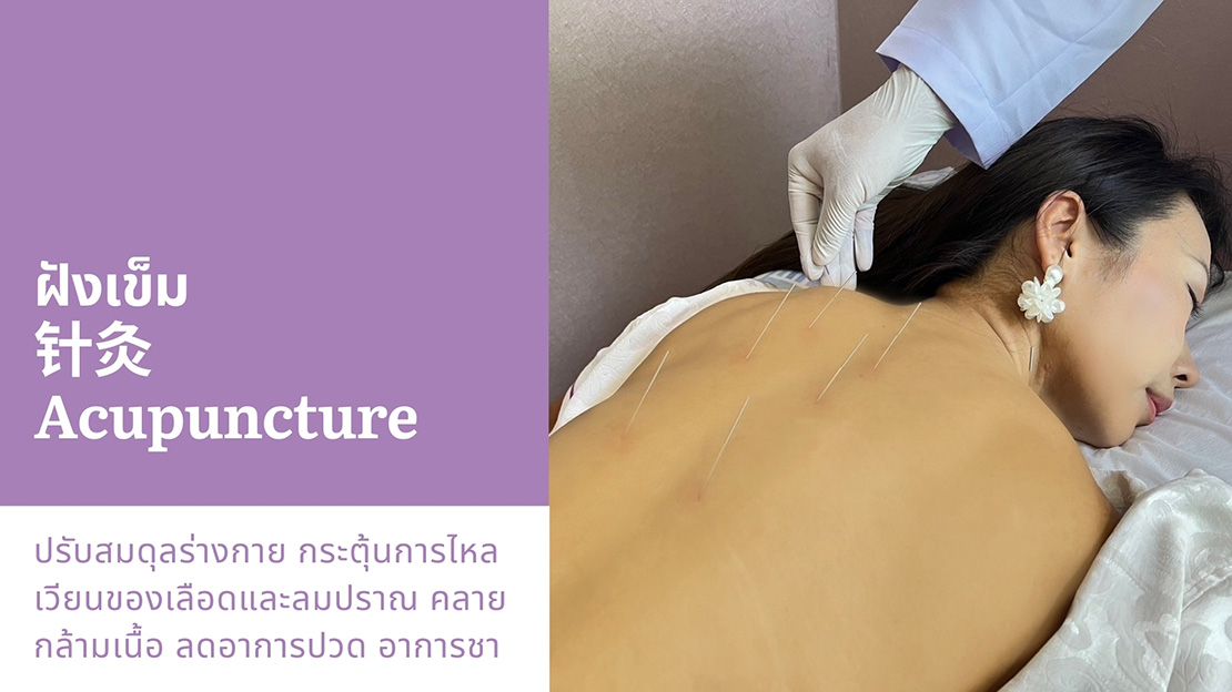 ฝังเข็ม 针灸 Acupuncture ปรับสมดุลร่างกาย กระตุ้นการไหล เวียนของเลือดและลมปราณ คลาย กล้ามเนื้อ ลดอาการปวด อาการชา